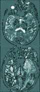 TBI Scan